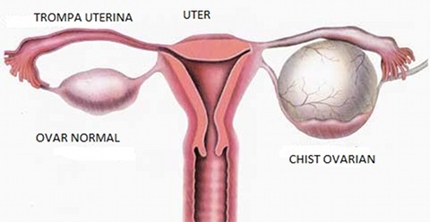 Chisturile ovariene dispar la menopauza